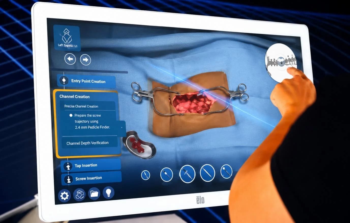 Tsym touchscreen showing a guided channel-creation step during pedicle screw insertion