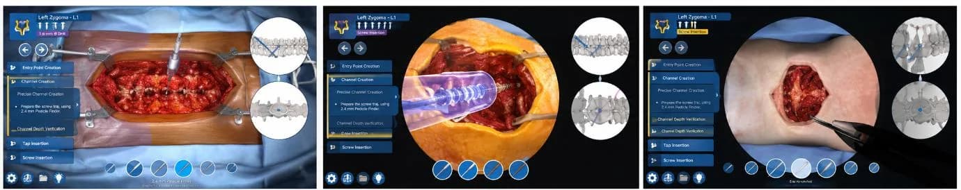 Surgical technique screens for screw insertion with fluoroscopy views